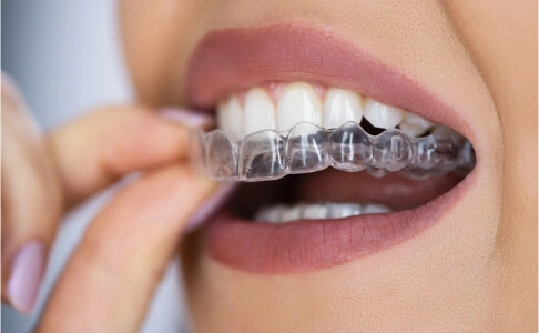 Clear Aligners