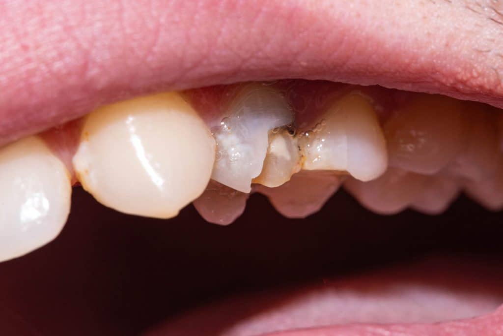 My Child Chipped a Tooth, Now What?